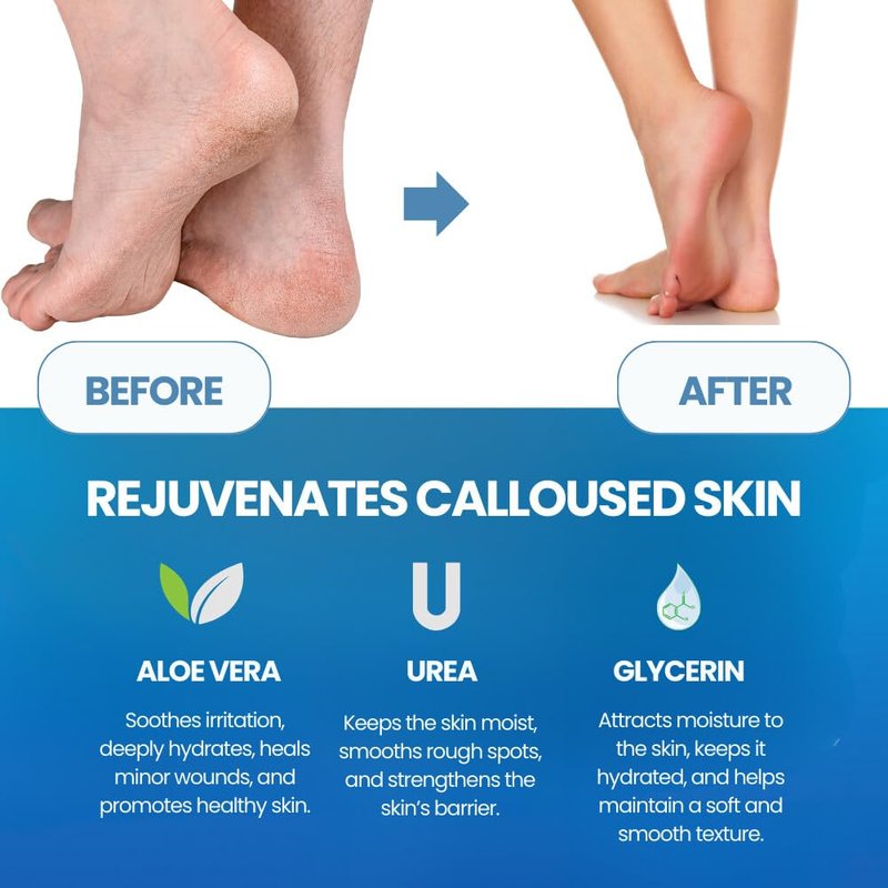 Imperial Feet Callus Remover for Feet Extra Strength Set – Callus Softener Spray + Stainless Steel Foot File, Hard Skin Remover for Dry Cracked Heels, Foot Dead Skin Remover for Pedicure