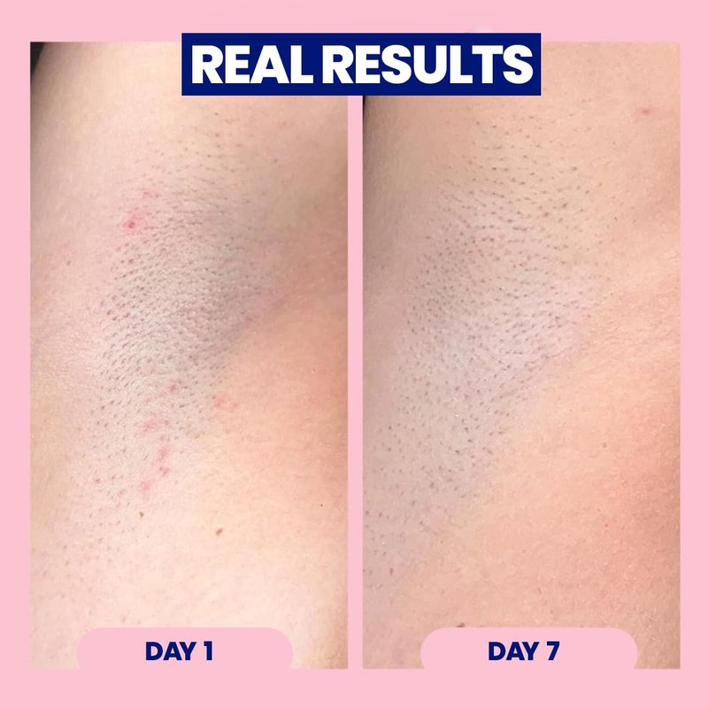 Mini Après Shave Roll-On Treatment for Women - Ingrown Hair & Razor Bumps | Travel Size 1.7 fl oz