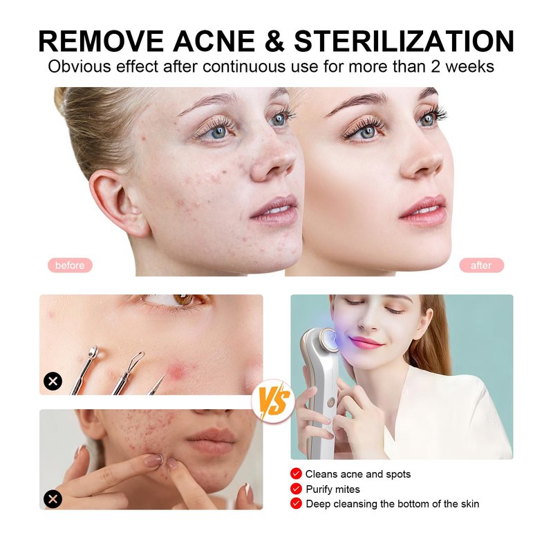 iMESA Plasma Face Device, Plasma Skin Device, Plasma Facial Device, Ozone Facial machine, Acne Machine for Face for Acne Removing, Anti-Wrinkle,Brightening,Tightening