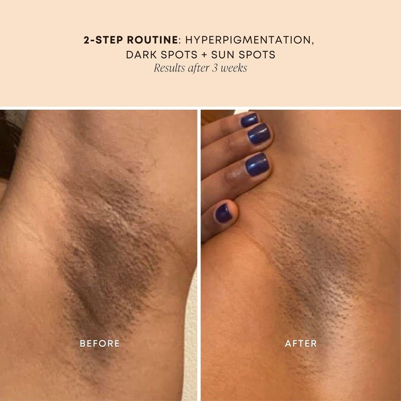 Bushbalm Dark Spot Oil - Improve Appearance of Dark Spots, Ingrown Hair All Over Body, Hydrates Skin, Rejuvenate and Nourish - 30ml Bermuda