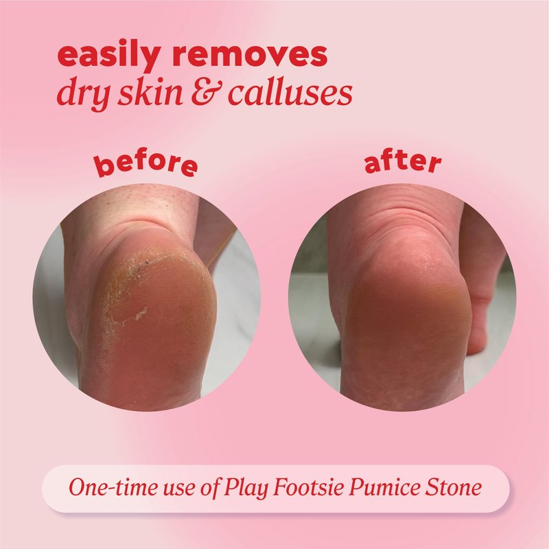Onyx Professional Double Sided Pumice Stone, 2 Pack - 100% Siliglass Callus Remover for Feet, Elbows, Knees, Dead Skin, Heels, Hands, Foot File Scrubber Exfoliator, Pumice Stone for Feet