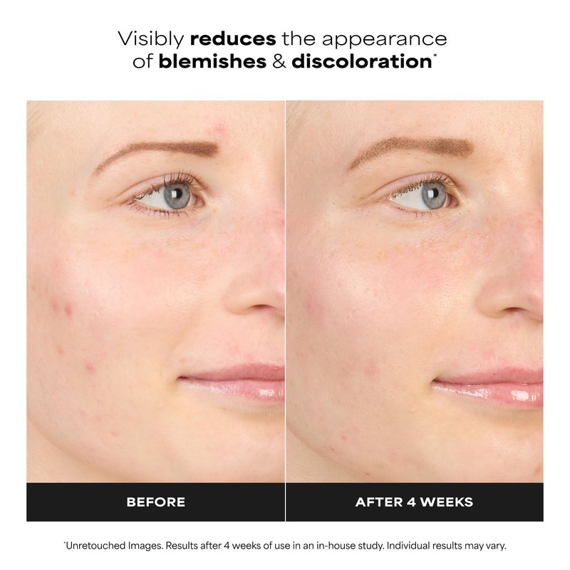 Paula’s Choice BOOST 10% Azelaic Acid Booster Cream Gel, Oil-Free Serum Fades Discoloration & Post-Blemish Marks, with Licorice Extract & Salicylic Acid, Fragrance-Free, 1 Fl Oz