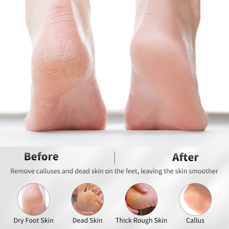 ÖkoStamm 4 PCS Natural Volcanic Pumice Stone for Feet - Rough Feet Scrubber with Hanging Rope for Dead Skin Removal, Pedicure Exfoliation Tool Use for Feet, Elbows, Knees