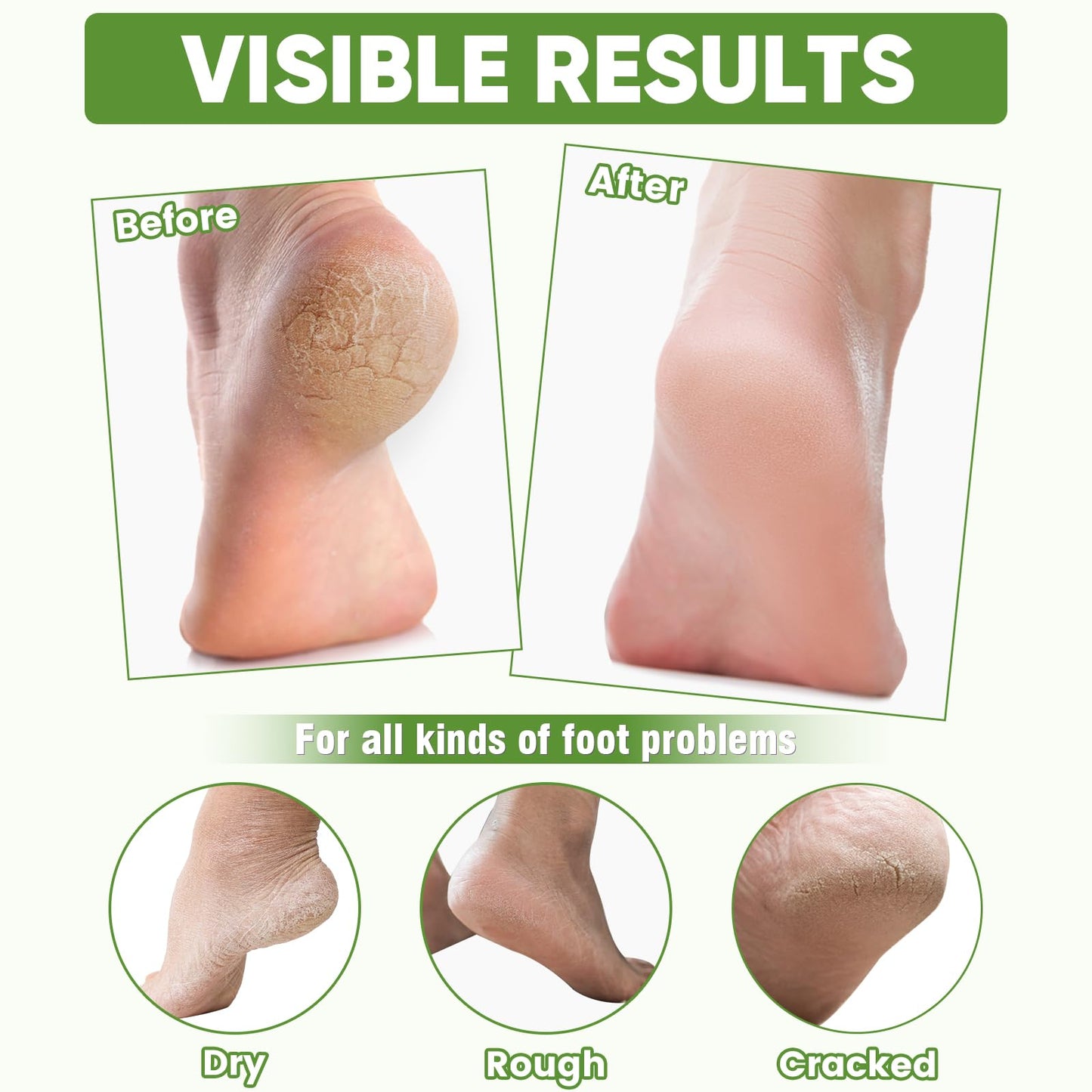 TEAWOO 8 Pairs Moisturizing Foot Masks with Aloe Vera Extract & Jojoba Oil, Intensely Hydrating Foot Mask for Dry Cracked Feet, Moisturizing Socks for Cracked Heel Treatment