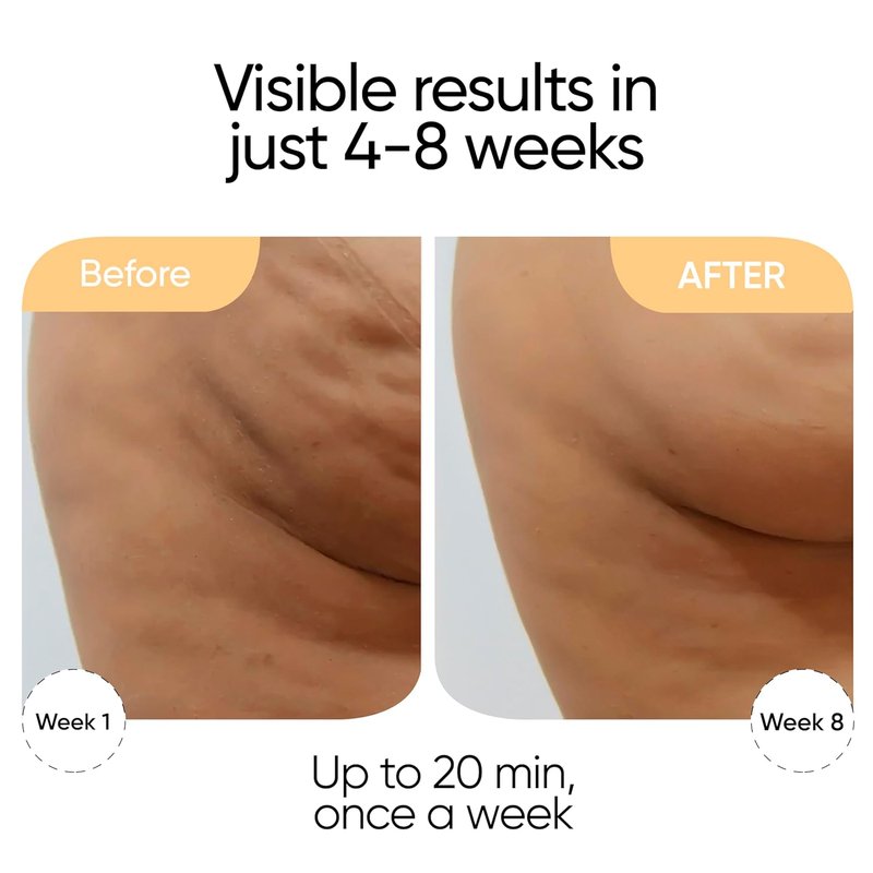 Sensica Sensifirm Radio Frequency Skin Tightening Device for Body – RF Body Sculpting Tool for Thighs & Buttocks, Firming & Smoothing, Cellulite Remover For Legs, At-Home Skincare Machine