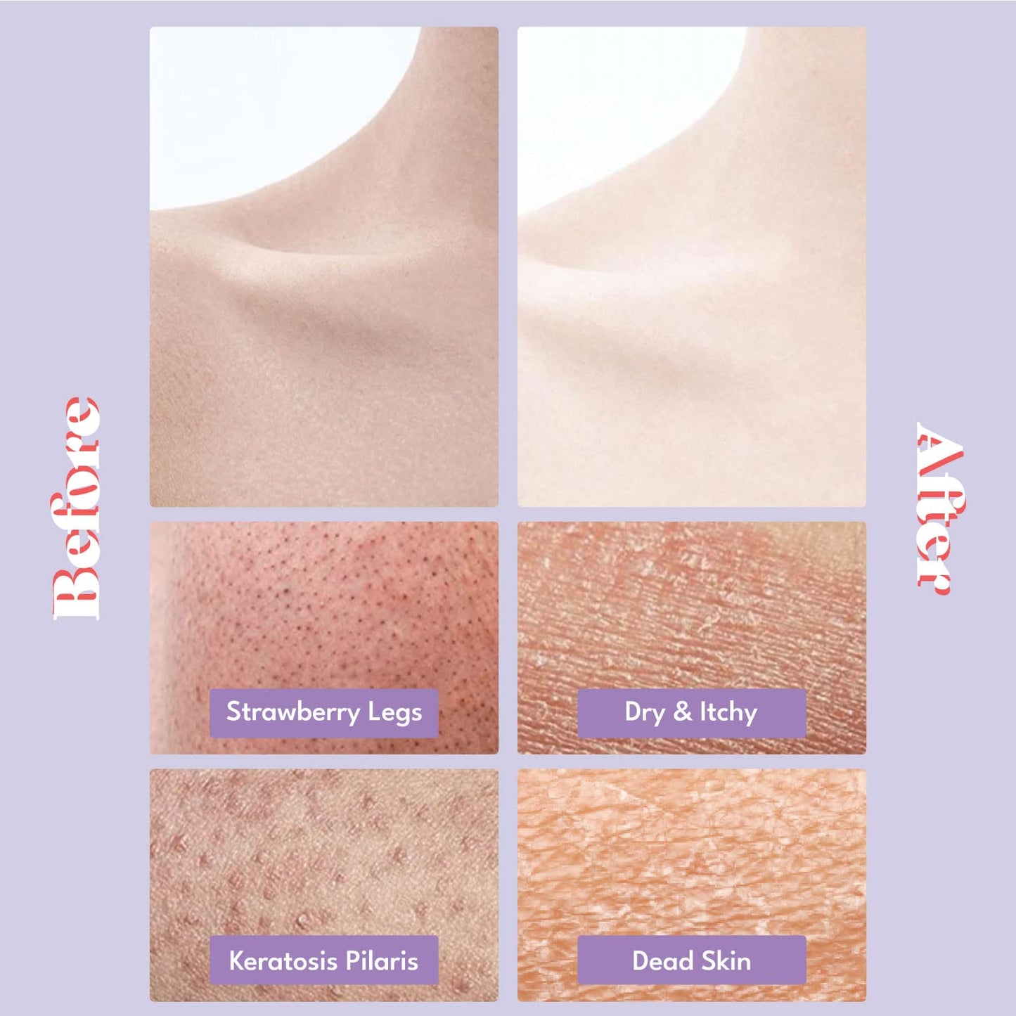Toi:L Gentle Touch Bubble Peeling Body Pad(5pads), Body Scrub, Exfoliating Mitt for Body, Exfoliating Gloves, washcloth, Body loofah, Dense Bubble Bath, Bath Shower, kp Bump Eraser