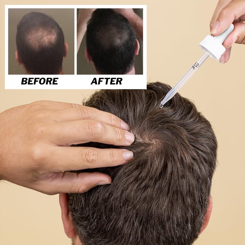 Shapiro MD Hair Growth Experts Hair Regrowth Kit Plus: Shampoo, Conditioner, Minoxidil, Leave-In Foamer. Anti Hair Loss and Thinning Hair Solution, 1 Month