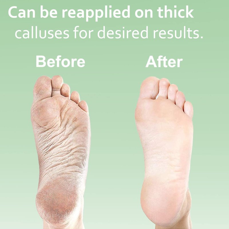 Dr. Entre's Callus Remover Gel Kit for Feet: Foot File, Pumice Stone, 5 Glove Pairs for Gel Application, Spa Kit, Foot Care, Pedicure Tools, Scrubber, 8oz