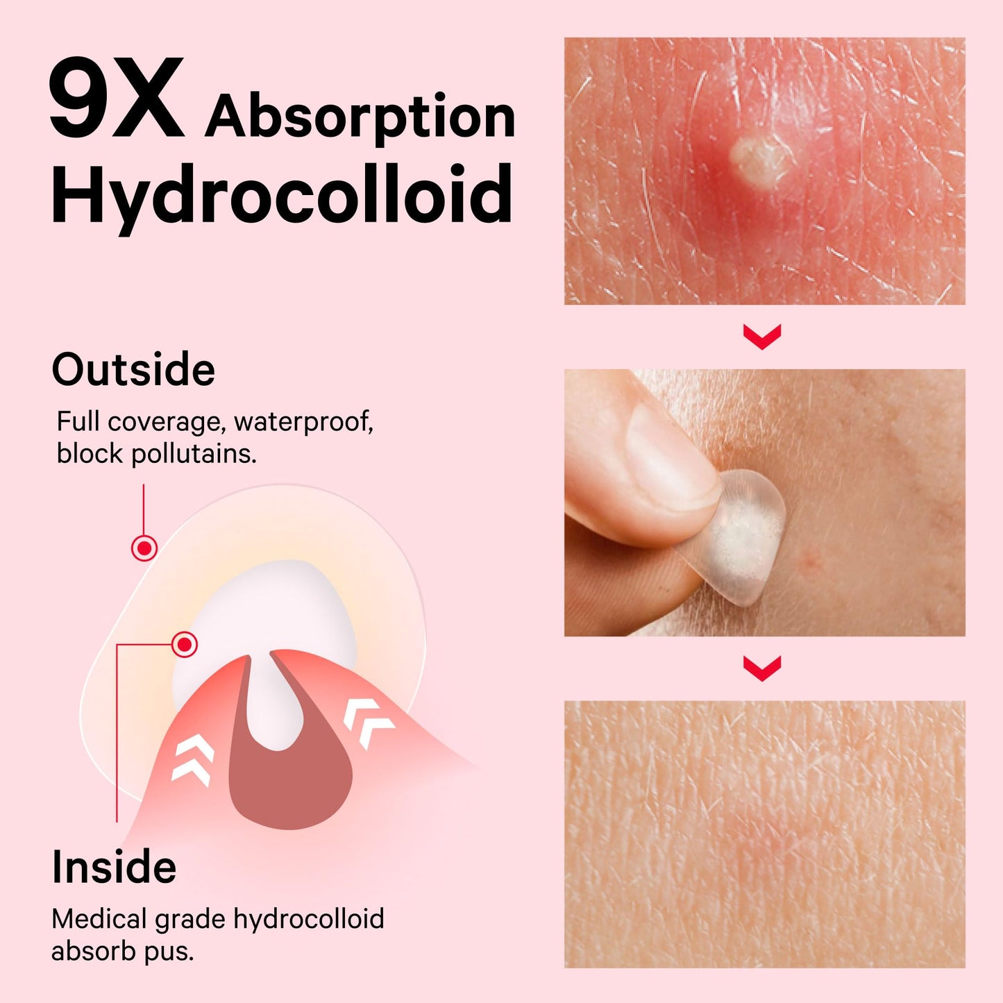 Sosky Pimple Patches for Face, Invisible Hydrocolloid Acne Patches, HSA Store Eligible Items, Zit Sticker for Face and Skin, Pimple Sticker for Covering Zits, Blemishes with Salicylic Acid 48 Count
