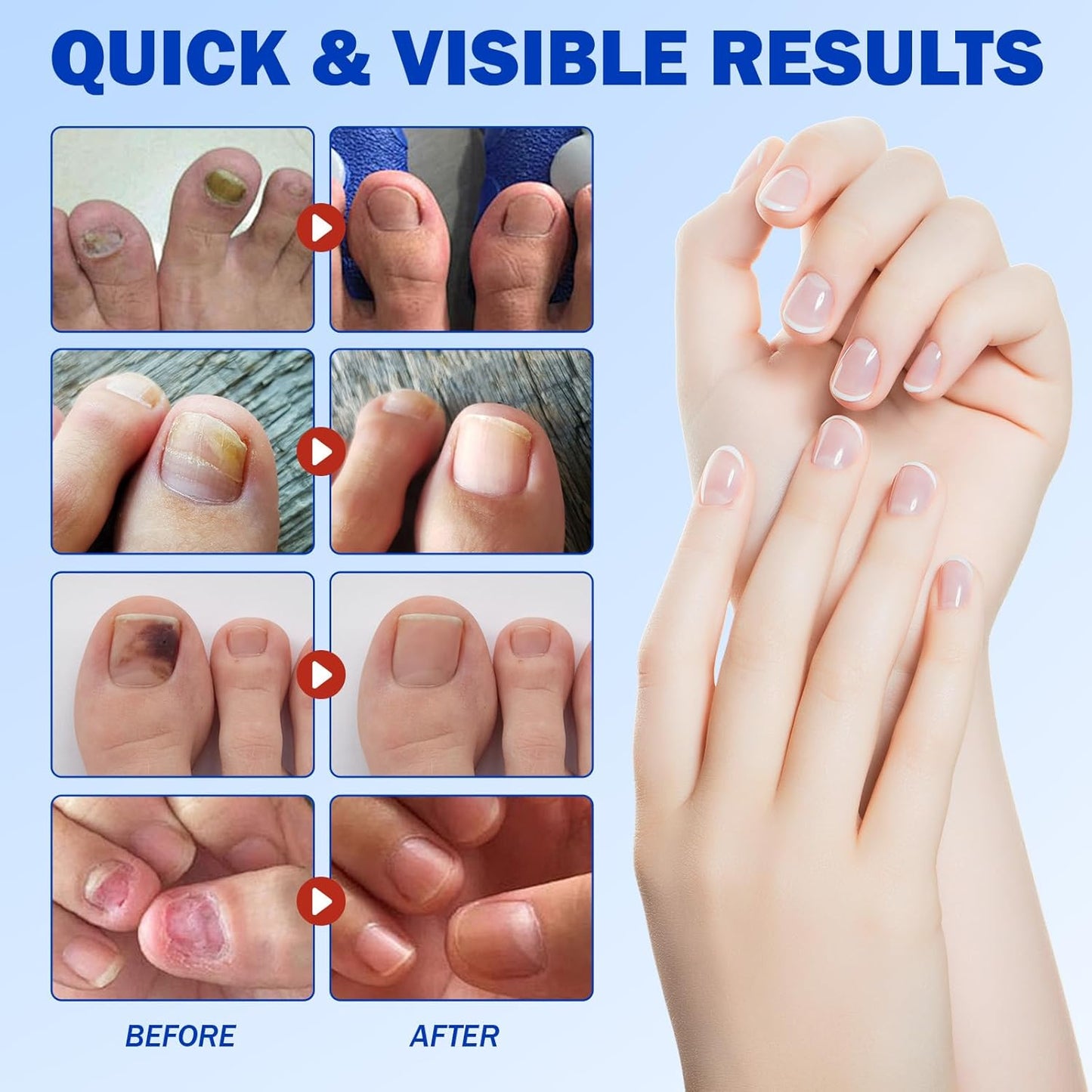 Skiennix Nail Patches for Toenail Repair - 42PCS Overnight Support for Damaged, Thick Toenails | Natural Formula
