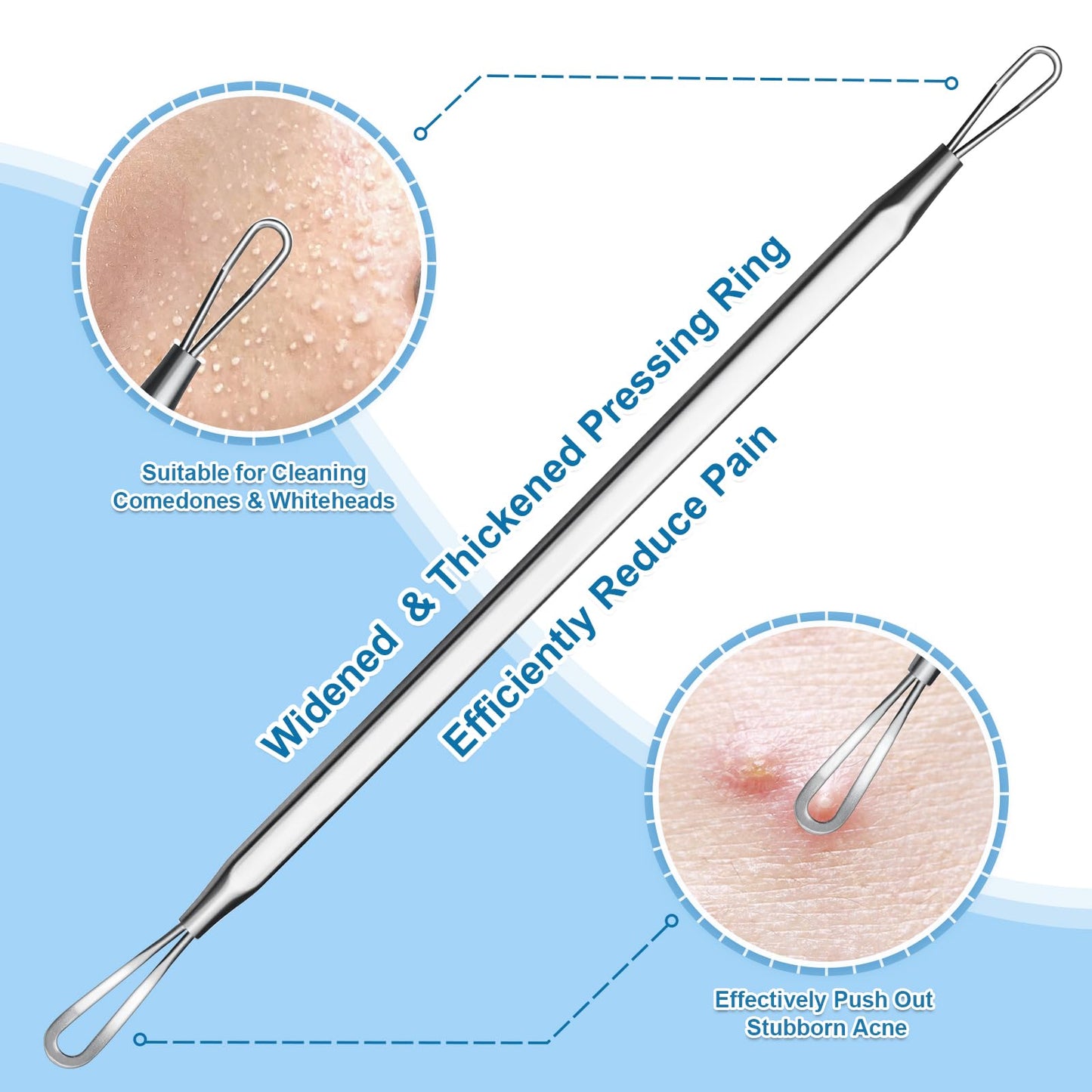 Vybiekr Stainless Steel Blackhead Remover, Pimple Extractor, Pimple Popper, Comedone Extractor, Surgical Grade Acne Treatment Tool, 3rd Generation Blemish Removal Kit for Face, Nose, T-Zone, 2Pcs