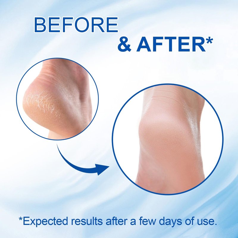 60% Urea Cream Stick with 2% Salicylic Acid, Maximum Strength Foot Cream Stick for Dry Cracked Heels & Calluses, Rapidly Softens Thick Skin - Non-Greasy & Fast Acting - 2-Day Visible Results