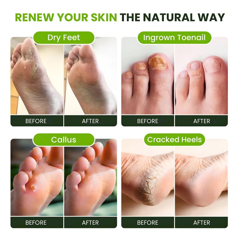 FOOT CURE Tea Tree Oil Foot Soak with Epsom Salts- for Foot Pain, Soreness, Athletes Foot, Odors, Toe Nail Fungus, Fungal, Calluses (Pack of 4)