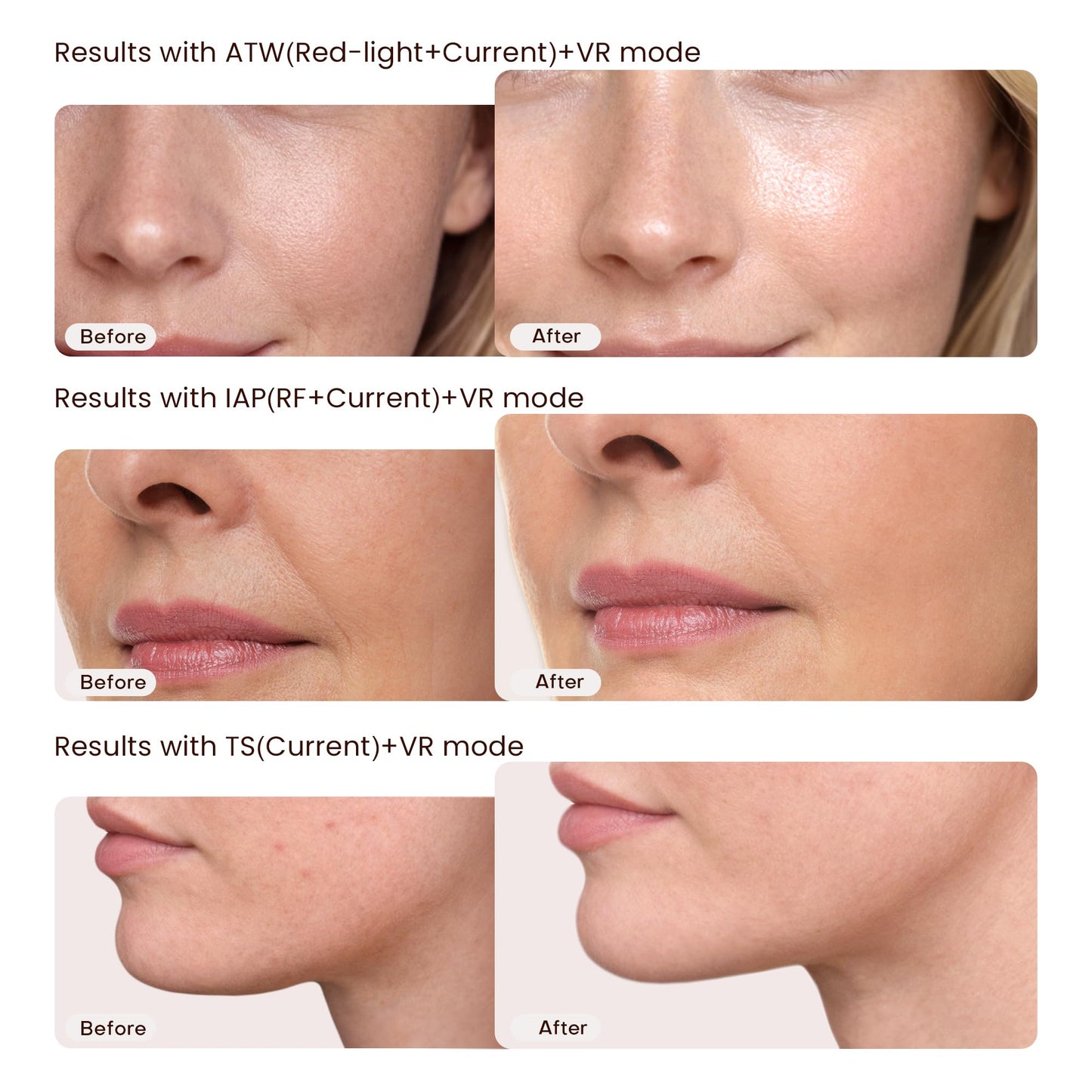 Skin Tightening Device | 6 in 1 Radio Frequency Skin Tightening Device | Professional Face Tightening | Lifting | Wrinkle Reducing | Depuff | Absorb | at Home RF Anti Aging Face Beauty Device