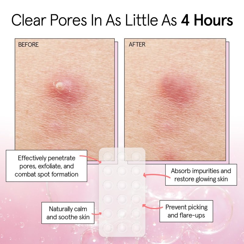 grace & stella Award Winning Pore Strip - Pimple Patches for Face - Hydrocolloid Acne Patches for Shrinking Zits, Breakouts - Spot Stickers - Dermatologist-Tested, Vegan (Invisible, 36 Count)