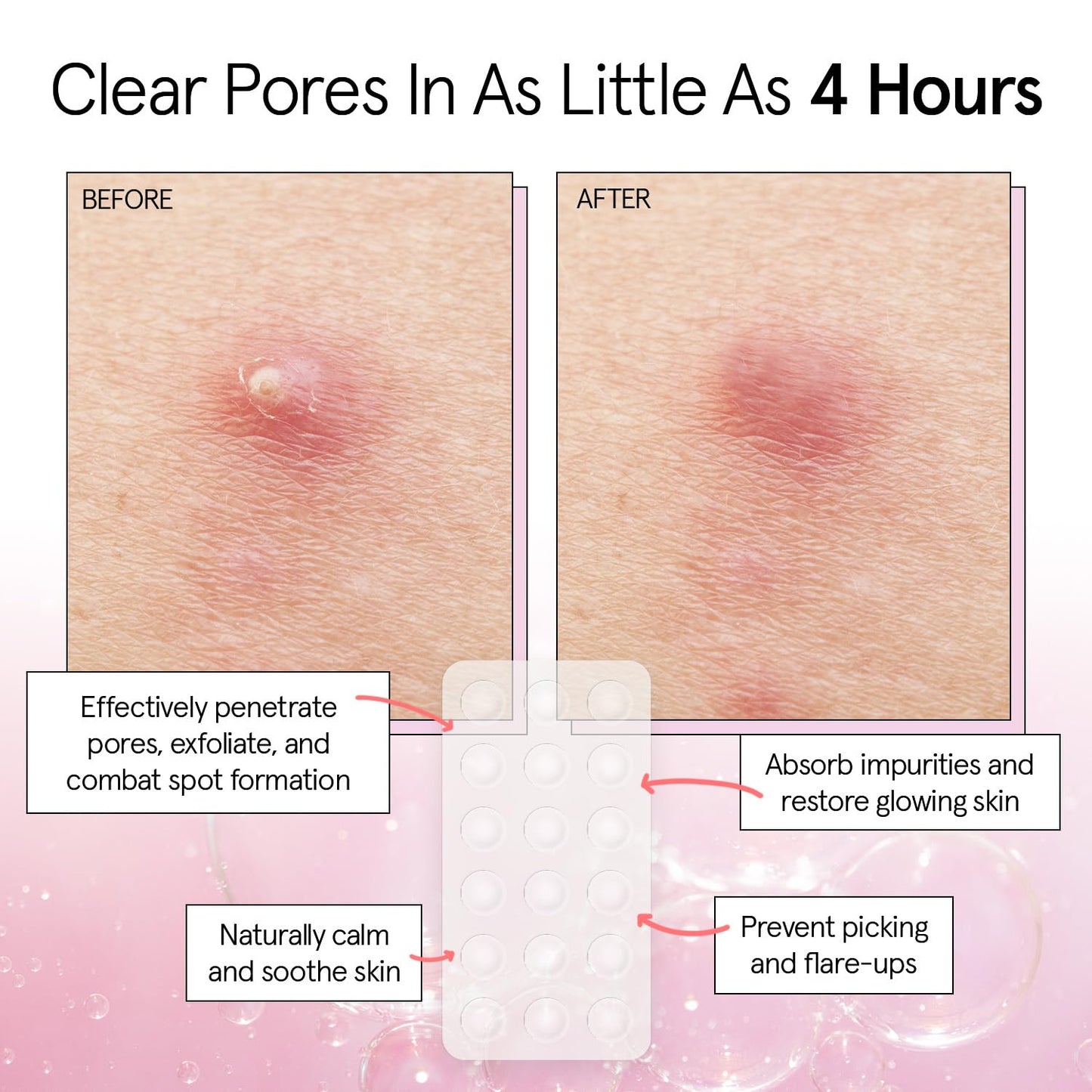 grace & stella Award Winning Pore Strip Pimple Patches for Face - Hydrocolloid Acne Patches for Shrinking Zits, Whiteheads - Spot Stickers - Dermatologist-Tested, Vegan (Invisible, 72 Count)