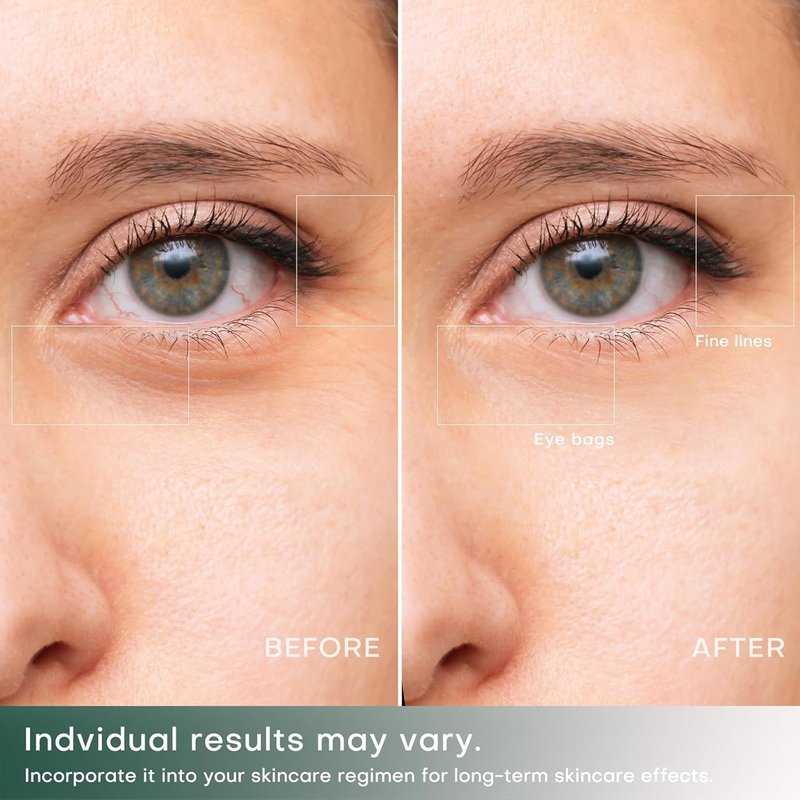 2 in 1 RF Microcurrent Eye Device - Professional Eye Care for Puffiness & Fine Lines | At-Home Anti-Aging Treatment