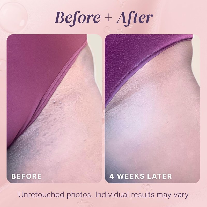 Razor Bump Stopper | Ingrown Hair Treatment with Dark Spot Remover - Salicylic Acid Solution for Bikini Area