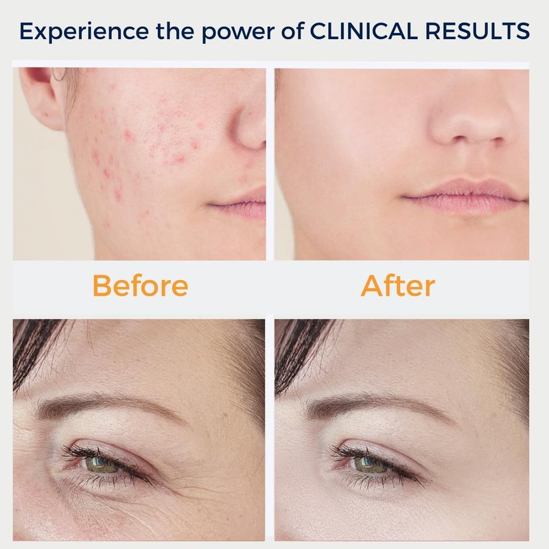 High Frequency Wand for Skin Care - Boost Collagen & Reduce Wrinkles | Portable & Easy to Use