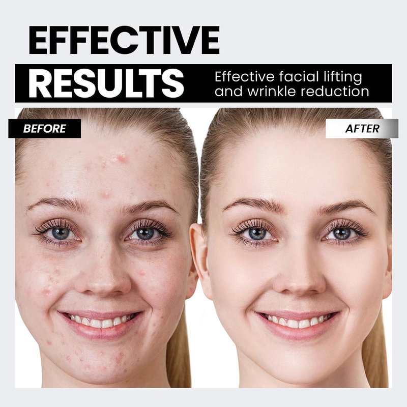 Microcurrent Facial Device - Red Light Technology for Lifting & Tightening Skin | Smart Photon EP-300