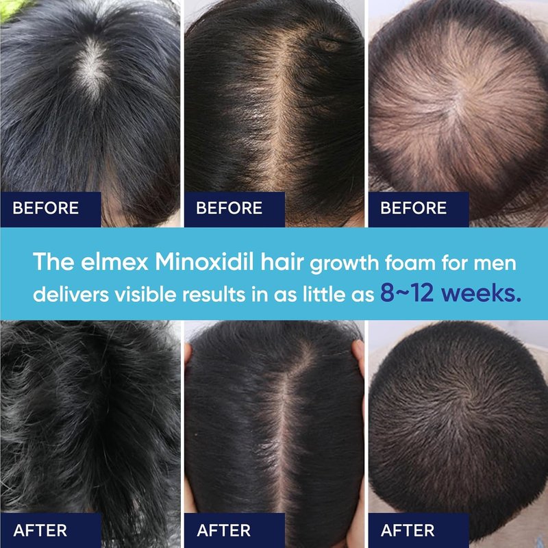 Regine Switzerland 5% Minoxidil Foam for Men & Women - Effective Hair Growth Treatment (60ML)