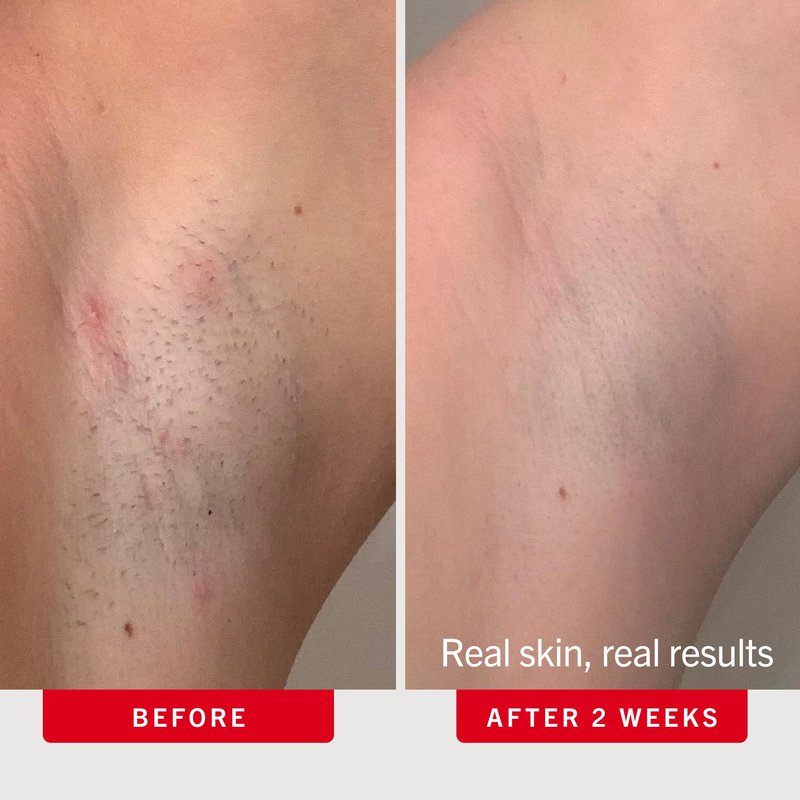 First Aid Beauty Ingrown Hair Pads, Body & Face with BHA & AHA - Dermatologist-Tested Aftershave Treatment to Help Prevent Razor Bumps & Exfoliate Underarms & Bikini Area - Sensitive Skin - 60 Count