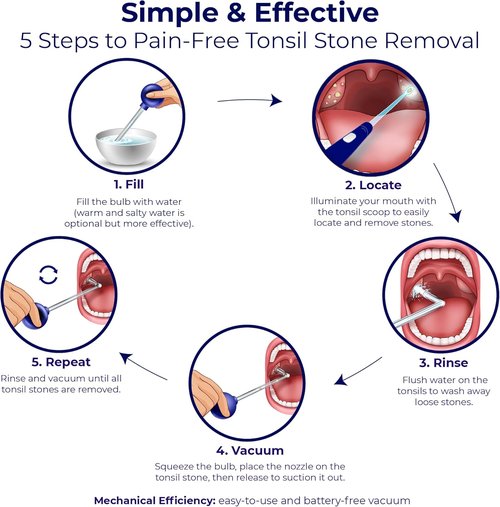 Oravix Tonsil Stone Vacuum, Tonsil Stone Remover Vacuum Suction, Tonsil Stone Cupping Tool, Tonsil Stone Removal Tool with Suction, Tonsil Stones Removal Vacuum, Tonsil Stone Extractor - 3 in 1 Kit