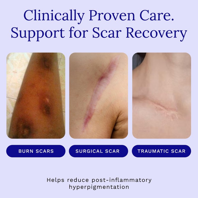 Rejuvaskin RejuvaSil Silicone Scar Gel, Scar Treatment for Surgical Scars, Burns, Keloids, Acne Scars on Face & Body, 30ml