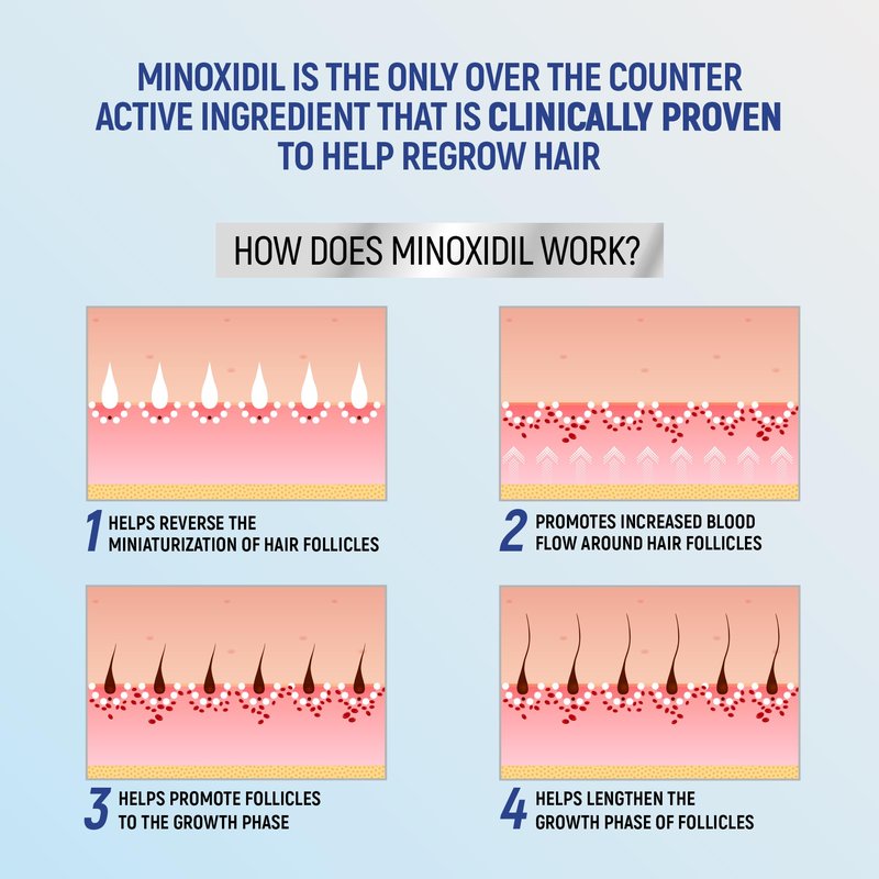 Minoxidil 5% Topical Aerosol Foam, Hair Regrowth 4 Months Treatment for Men, 2.11 oz (4 Pack)