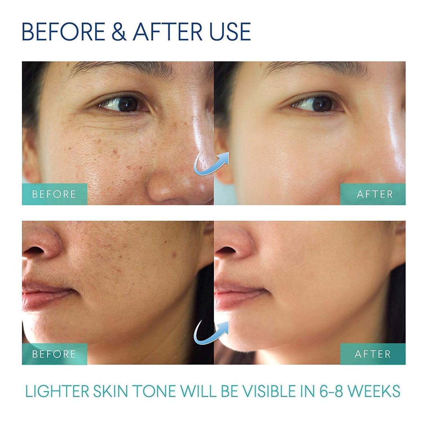 Skiennix Razor Bump Treatment - Effective Ingrown Hair Solution for Bikini, Face, Neck & Legs