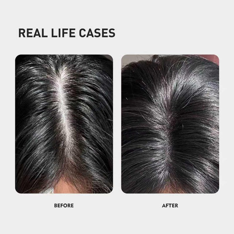 KINTOR 0.9% KX-826 DHT Blocker for Men & Women Hair Growth,Hair Growth Products Spray 60ml Pro