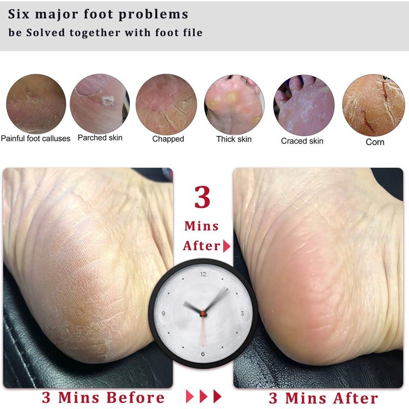 Kinepi Foot Scrubber - Professional Pedicure Tool for Callus Removal & Cracked Heels | Foot Care Kit for Men & Women
