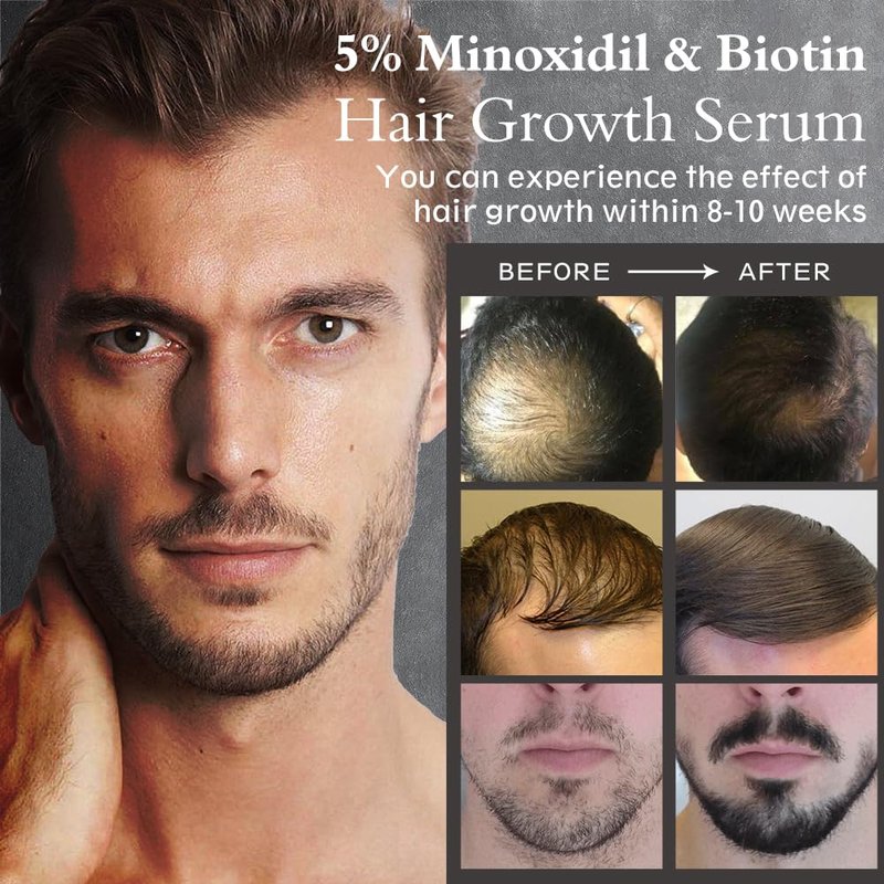 Ruahouine Hair Growth Serum - 5% Minoxidil & Biotin for Thicker, Longer Hair | 2.11 fl. oz