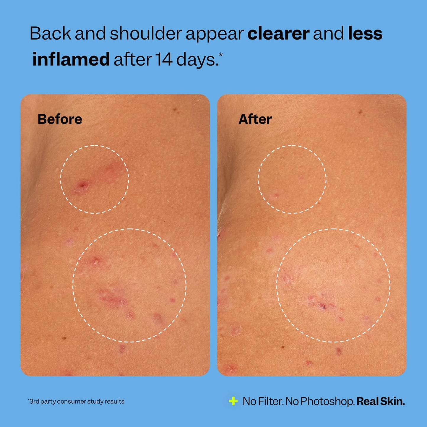 Peach Slices - Breakout Banisher Body Spray (4 oz) - 1% Salicylic Acid, Glycolic Acid - Clear & Prevent Body Breakouts - Niacinamide, Beta-Glucon, Aloe - Vegan, Cruelty Free, Korean Skin Care & Beauty