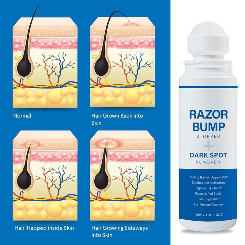 Razor Bump Stopper - Ingrown Hair Treatment for Men & Women | After Shave Solution, 3.38 Fl Oz