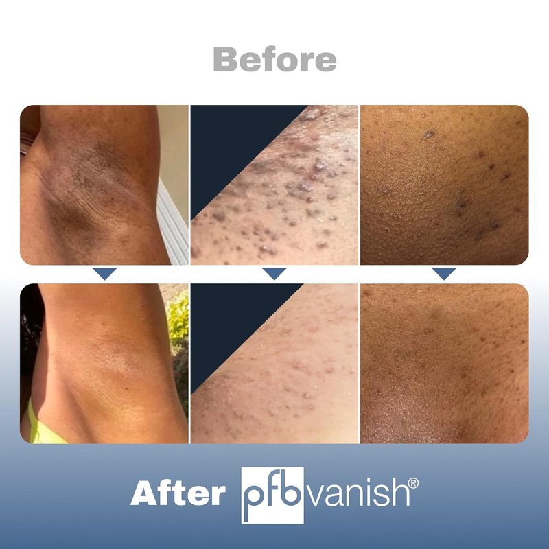 PFB Vanish Razor Bump Stopper | Skin Care Treatment with Chromabright Dark Spot Remover - 93g