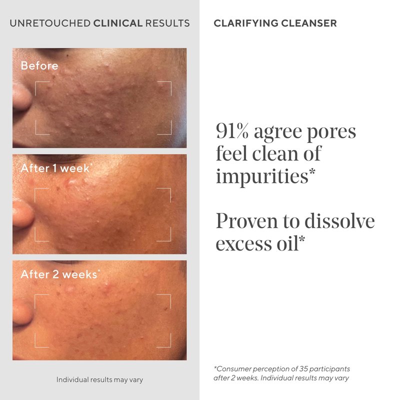 Murad Acne Control Clarifying Cleanser – Salicylic Acid & Green Tea Formula for Acne, Deep Pore Cleansing, Oil Control & Breakout Prevention for Clear, Balanced, Healthy-Looking Skin (5 Fl Oz)