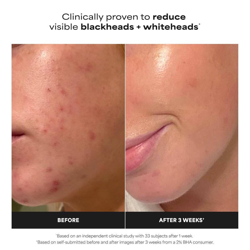 Paula's Choice Skin Perfecting 2% BHA Liquid Exfoliant - Salicylic Acid Facial Polish for Pores & Fine Lines | Fragrance-Free, 4 oz