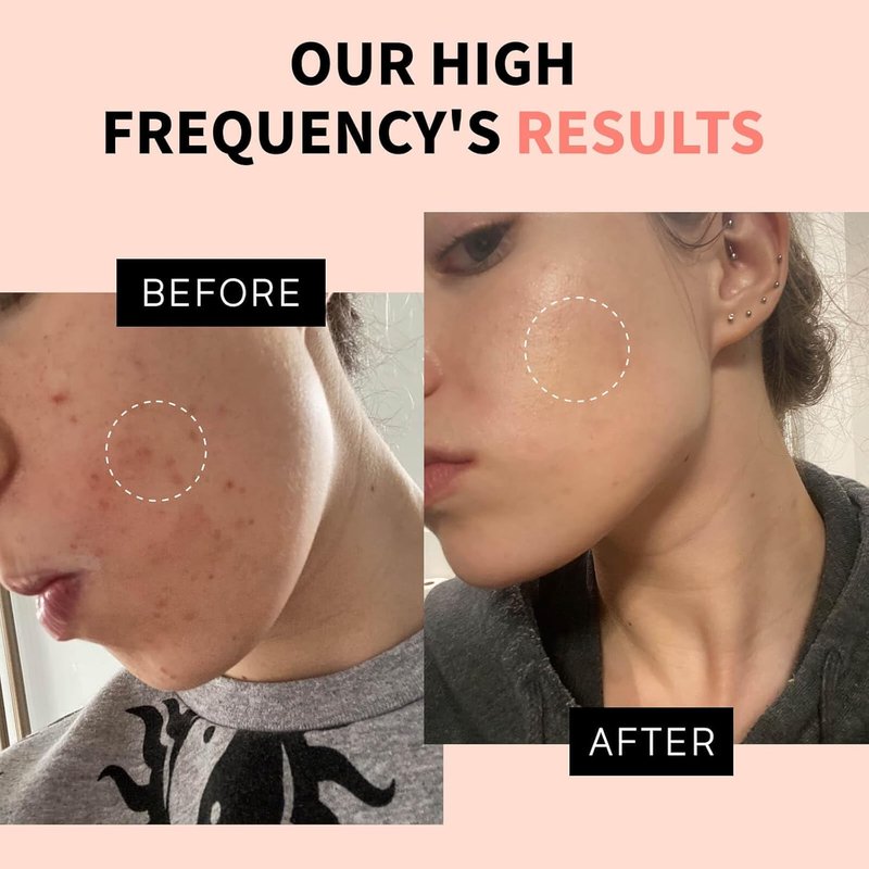 OxyGlow Cordless High Frequency Facial Machine | Pro Facial Wand for Clinical Skin Therapy