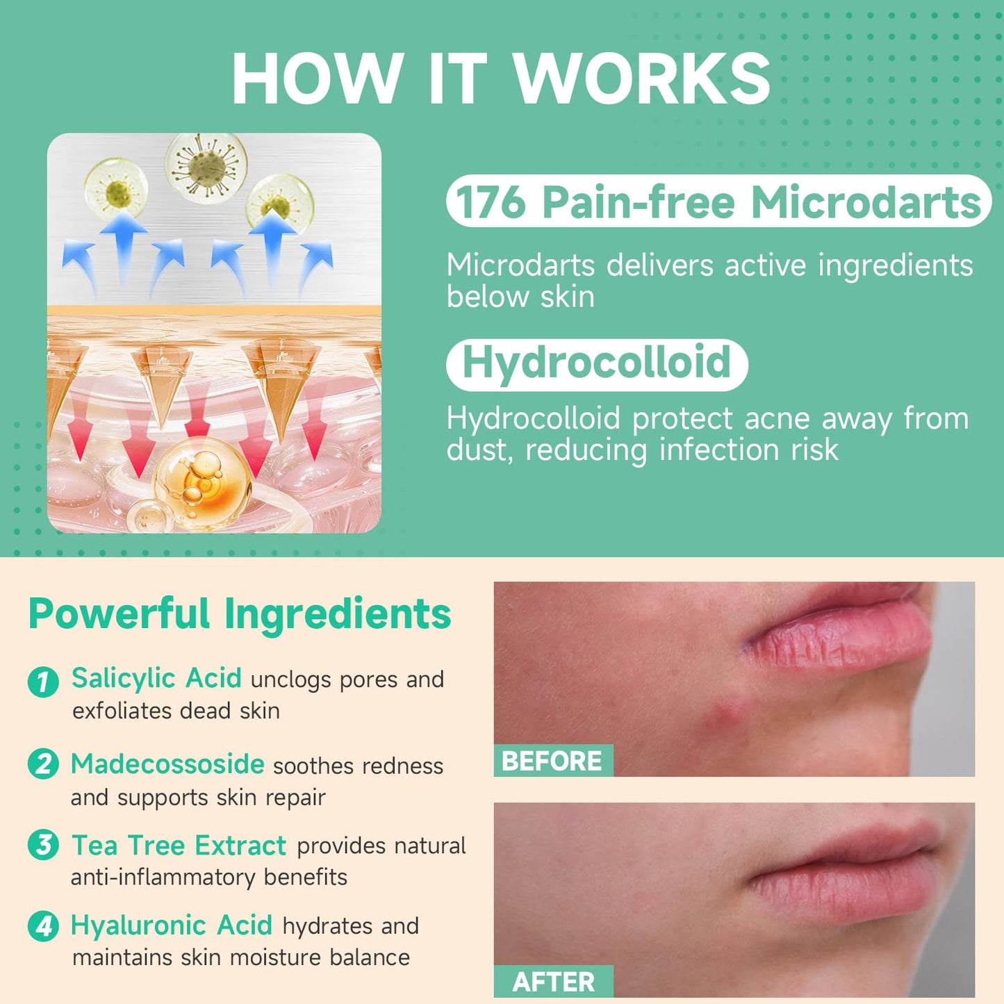 TEAWOO 36-Count Microdart Pimple Patches, Hydrocolloid Acne Patches with Salicylic Acid & Madecossoside, Microdart Zit Patches for Deep Blemishes & Early Stage Acne (Patented)