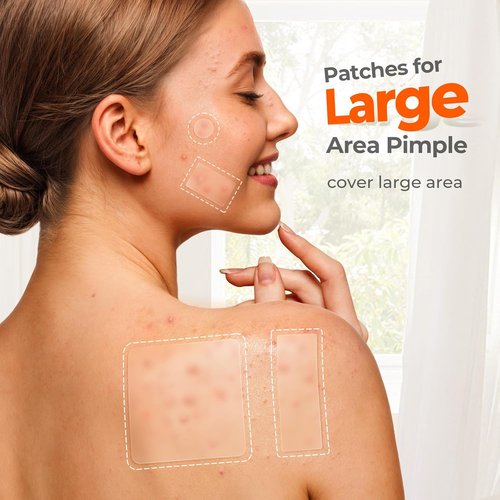TKTK Large Pimple Patches for Face, 7 Sizes XL Acne Patches, Big Hydrocolloid Bandages for Body, Chin, Forehead, Chest, Back Zit Breakouts, Hydrocolloid Patch (Strip, Square, Dot 302 Count)