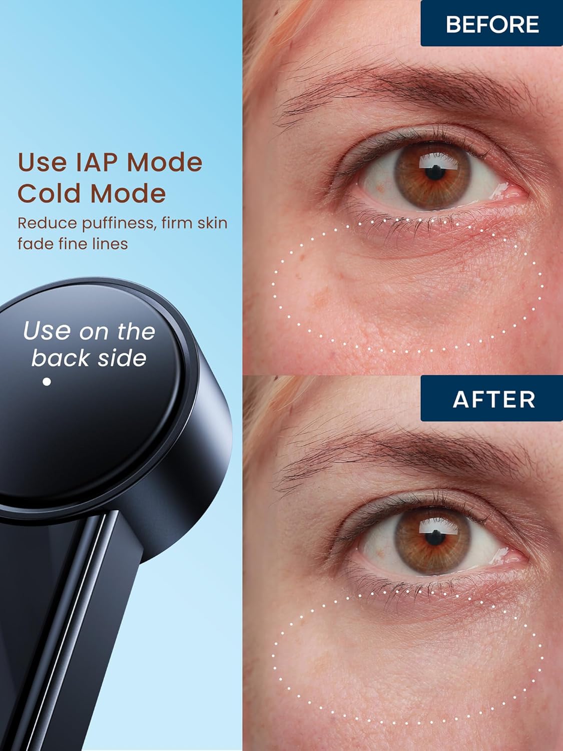 Skiennix Radio Frequency Skin Tightening Device - Smart Electric Facial Beauty Machine for Jawline Lifting & Wrinkle Reduction