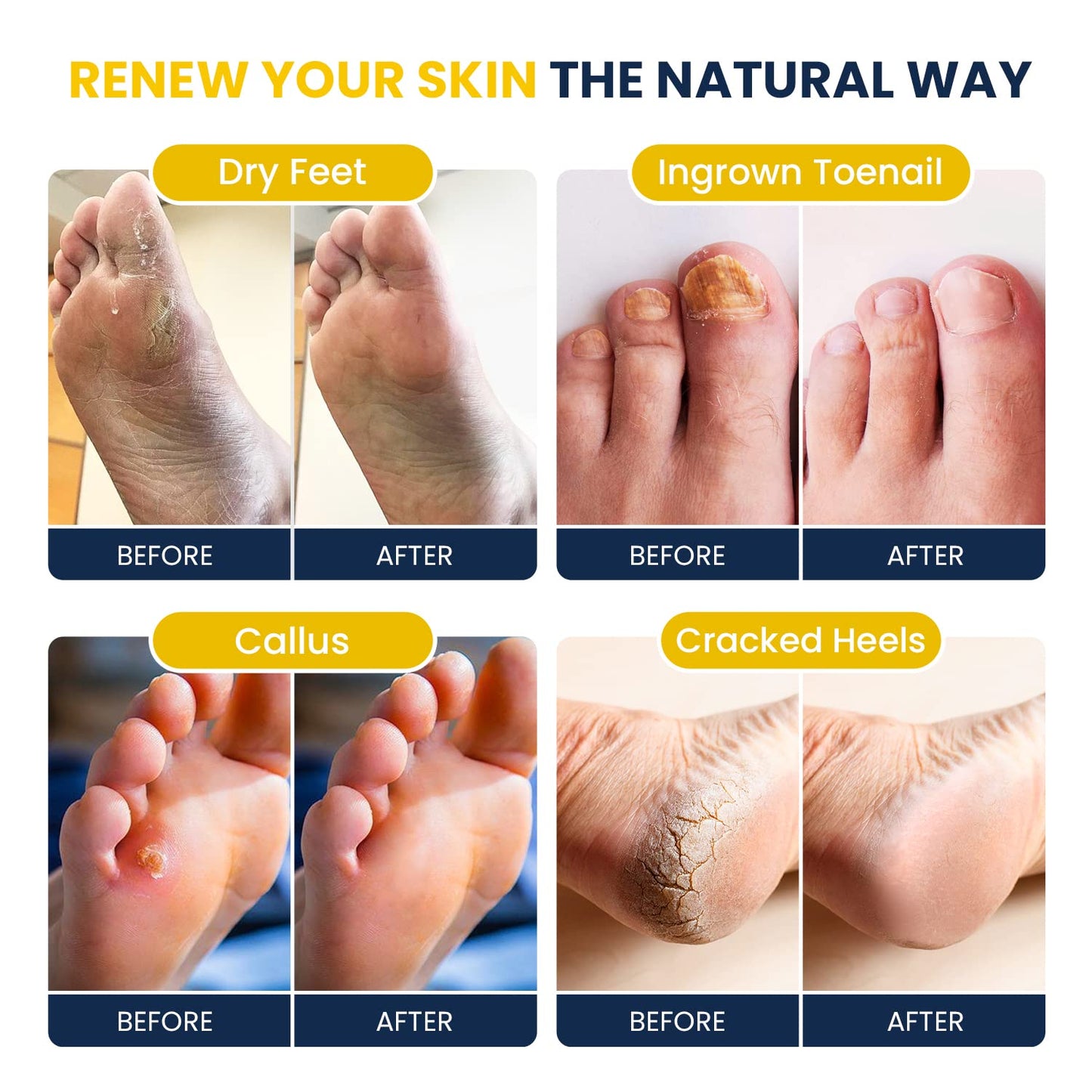 FOOT CURE Citrus Detox Foot Soak With Epsom Salts for Foot Callus, Immune Boost, Damaged Toenail, Athletes Foot, Pedicure and Soothes Tired Aching Feet - 16 oz (Pack of 2)