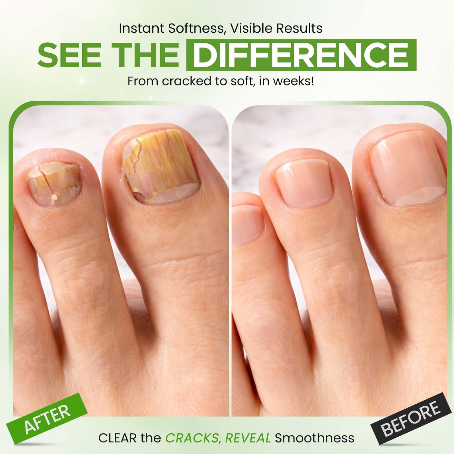 Urea Nail Gel - Softens Cracked Heel Calluses & Thick Toenails - Repairs Damaged, Yellow, Discolored Nails – Highly Effective & Quick-Dry Fingernails & Toenail Treatment (Urea 40%)