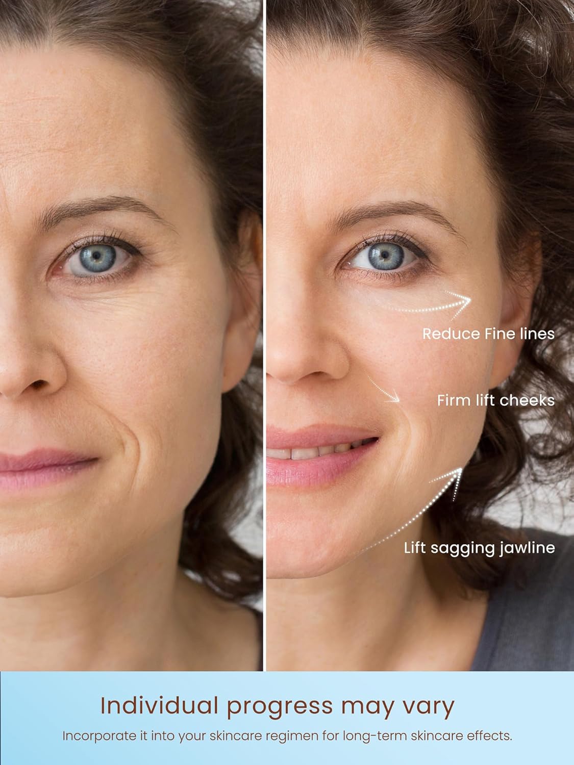 Skiennix Radio Frequency Skin Tightening Device - Smart Electric Facial Beauty Machine for Jawline Lifting & Wrinkle Reduction