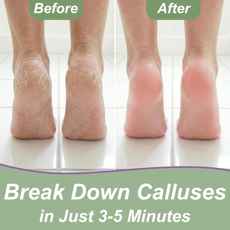 Dr. Entre's Callus Remover Gel - Extra Strength Foot Care Solution for Smooth Feet | 4 oz