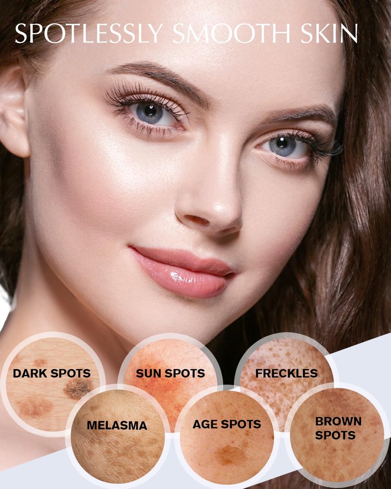 Dark Spot Remover for Face and Body: Hyperpigmentation Treatment - Natural Ingredient - Freckle/Melasma/Sun Spot/Age Spot Remover - Dark Spot Corrector Cream for Women and Men