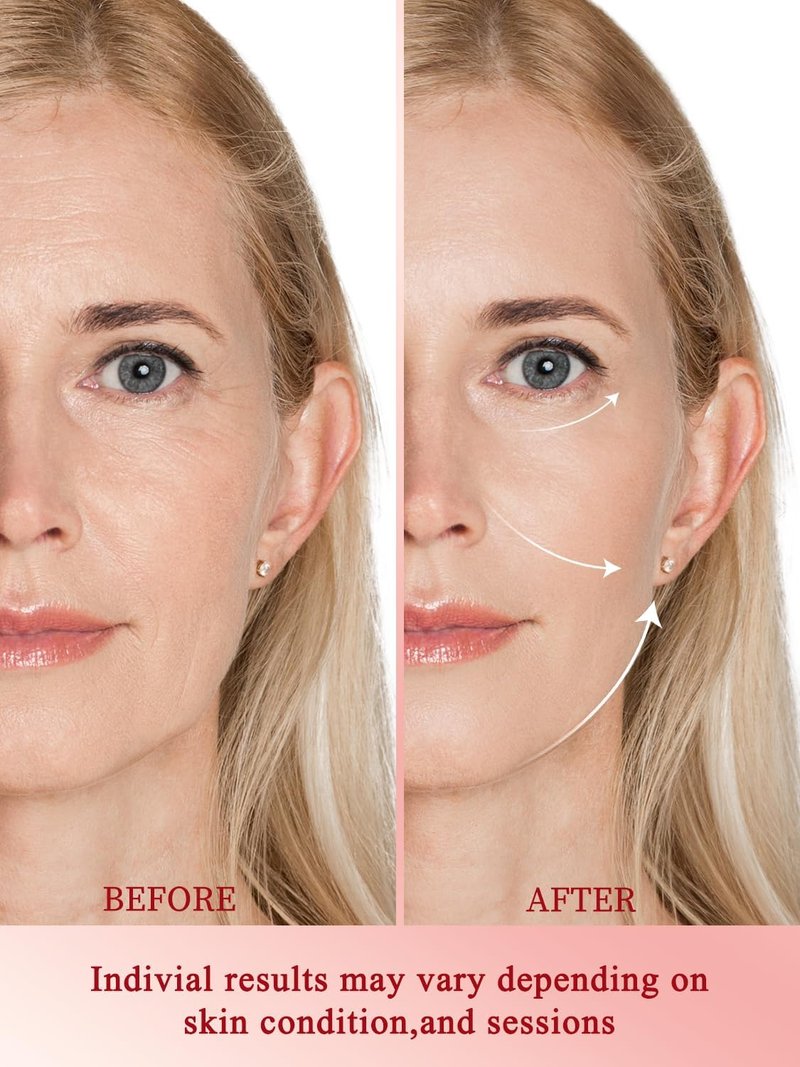 Radio Frequency Skin Tightening Device - Anti-Aging Face Machine for Wrinkle Removal & Firming | Wireless Home Beauty Tool with 3 Levels