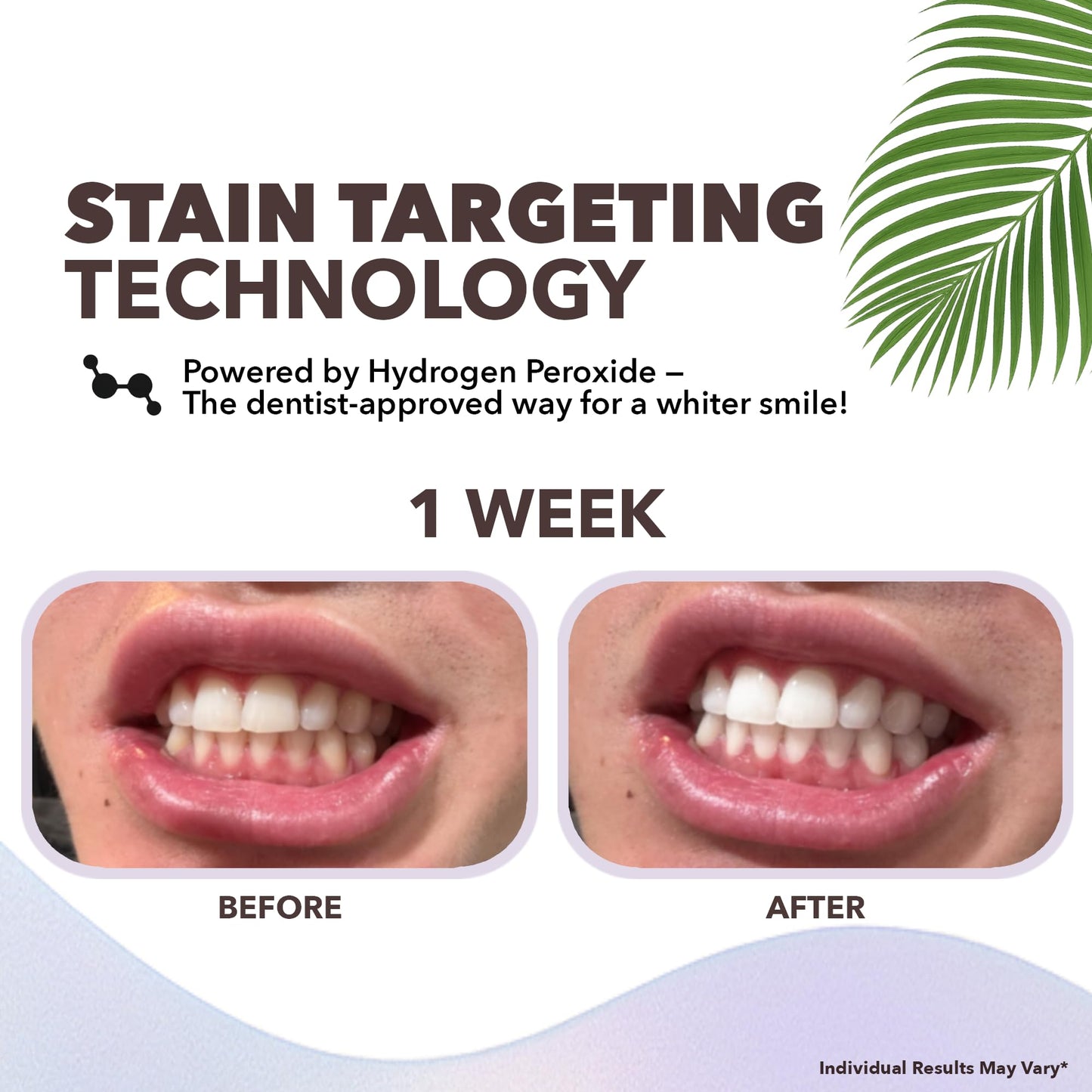 Purli Professional Teeth Whitening Strips 9-Day Treatment – Purli Whitening Strips for Sensitive People, Natural Coconut Oil, Professional Effects, Gum & Enamel Safe, Dry Strip