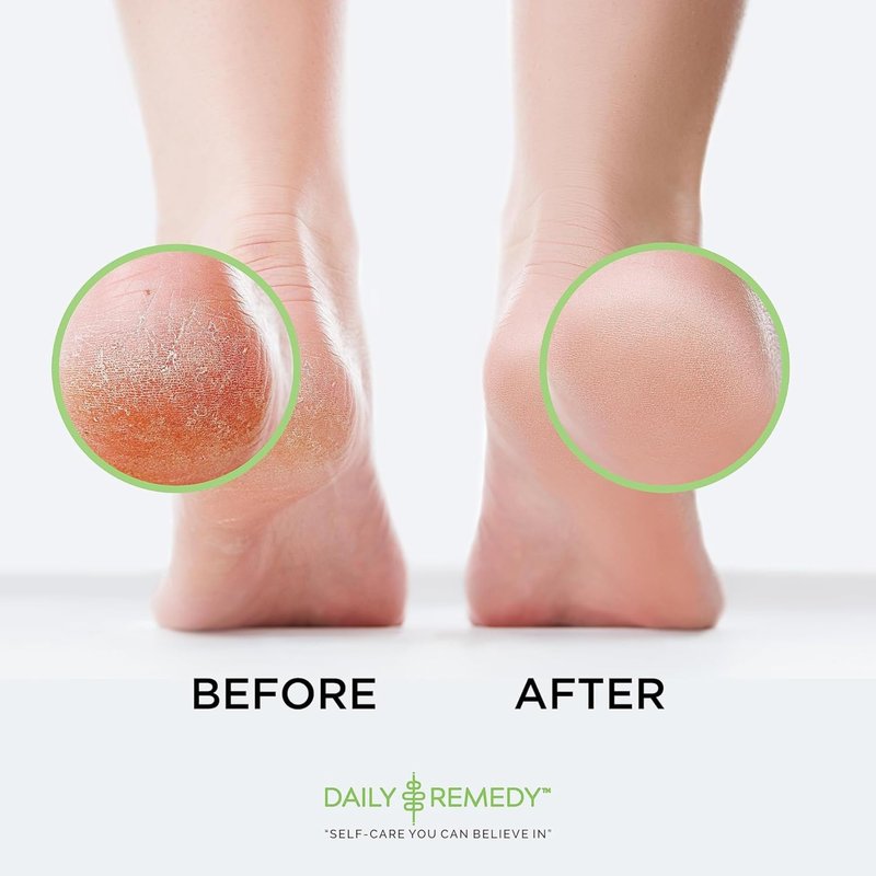 Callus Remover Gel – Professional Foot Callus Removal for Smooth Feet & Cracked Heels – Extra Strength Callus Gel with Pumice Stone – 8oz, Made in USA